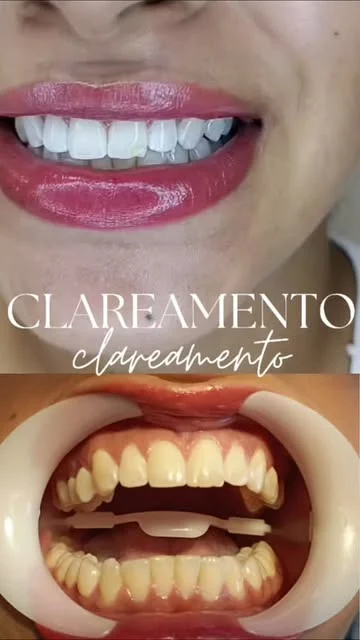 Antes e depois de clareamento dental feito pela Dra. Jercilene
