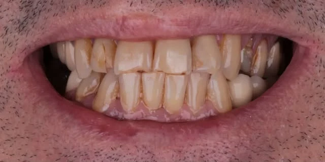 Antes: desgaste e manchas nos dentes superiores
