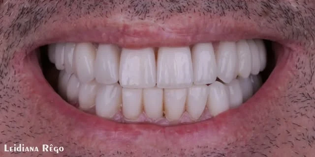 Depois: desgaste e manchas nos dentes superiores
