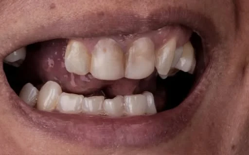 Antes: ausência de dentes e desalinhamento