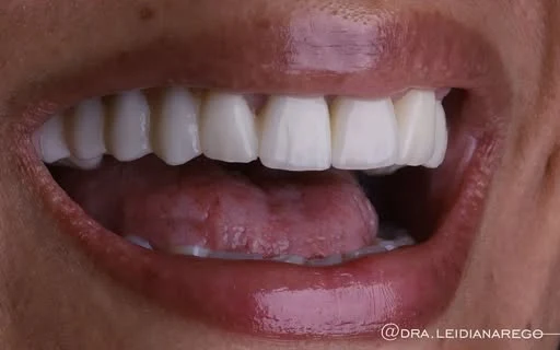 Depois: ausência de dentes e desalinhamento