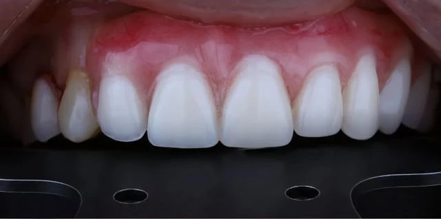 Antes: dente escurecido e falha na arcada superior