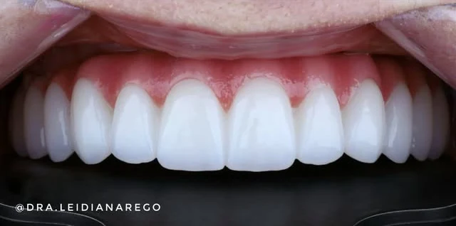 Depois: dente escurecido e falha na arcada superior