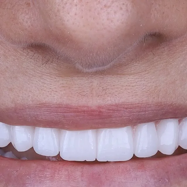Sorriso após reabilitação com facetas e implantes