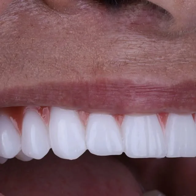 Sorriso natural após tratamento