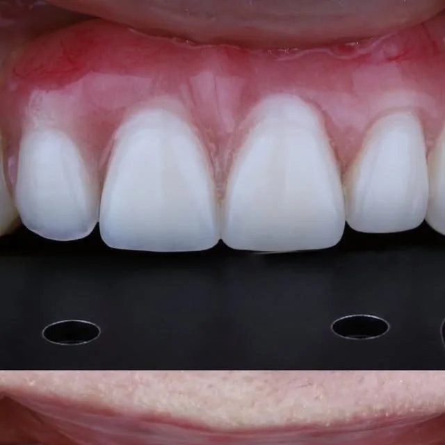 Detalhe de coroas sobre implantes