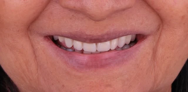 Antes: dentes desalinhados e escurecidos