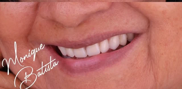 Depois: sorriso com facetas