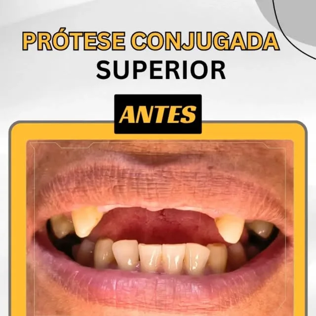 Antes e depois de prótese conjugada superior