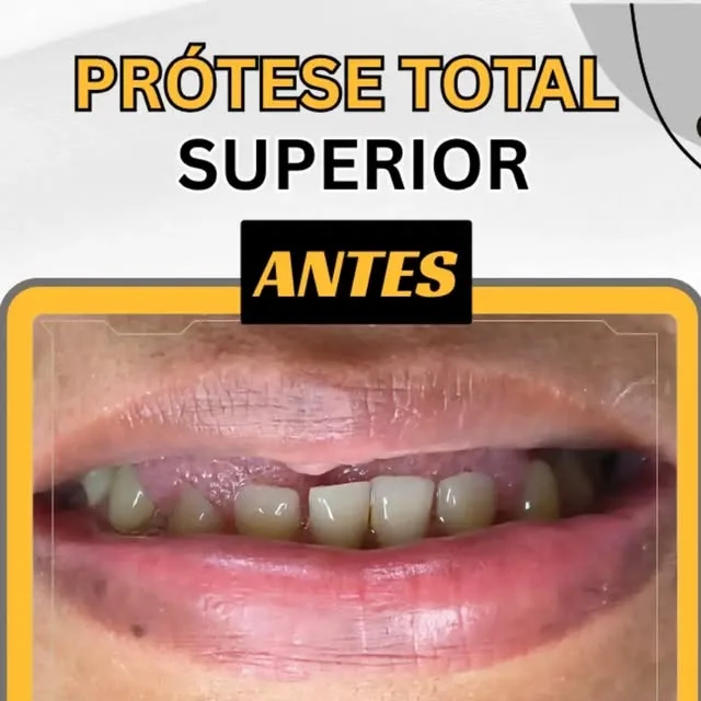 Antes e depois de prótese total superior