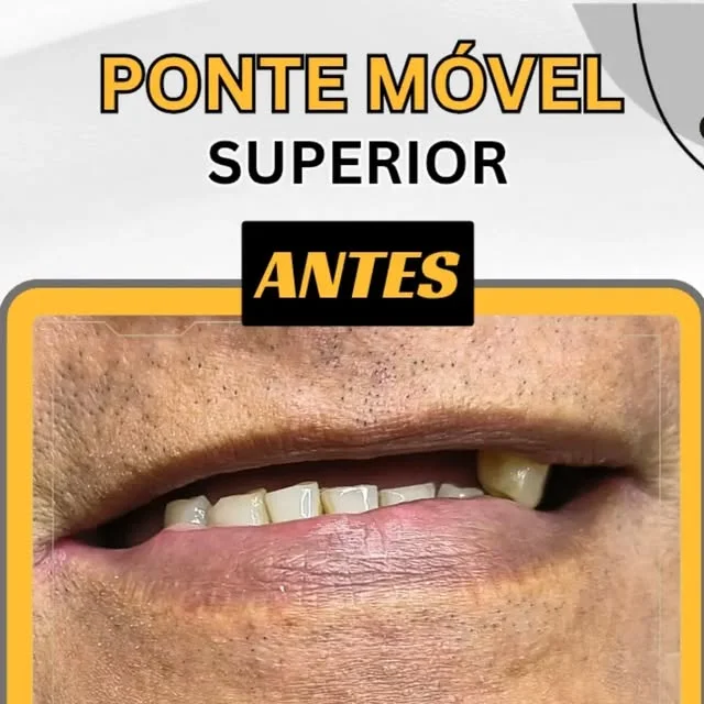 Antes e depois de ponte móvel superior