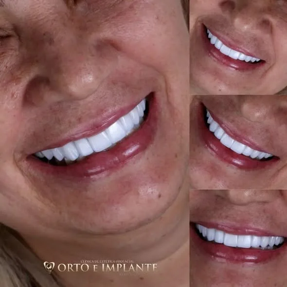 Sorriso com lentes de porcelana, vista lateral