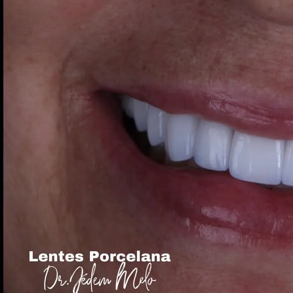 Sorriso com lentes de porcelana