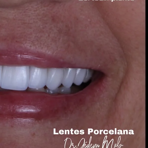 Sorriso após lentes de contato