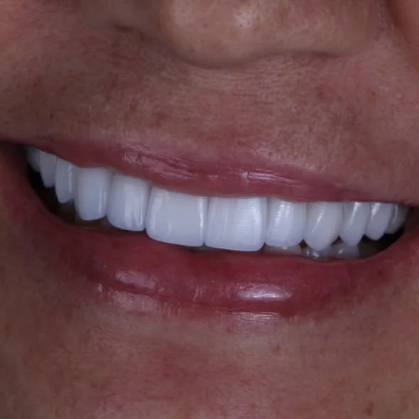 Sorriso após reabilitação