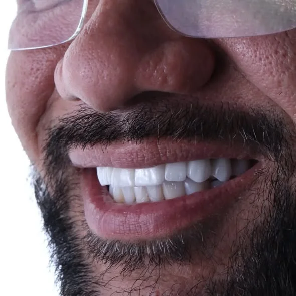 Sorriso masculino após lentes