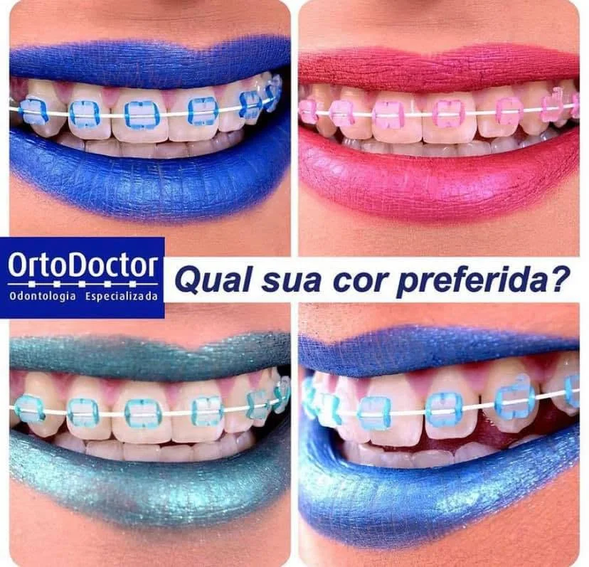 Sorrisos com borrachinhas de cores diferentes