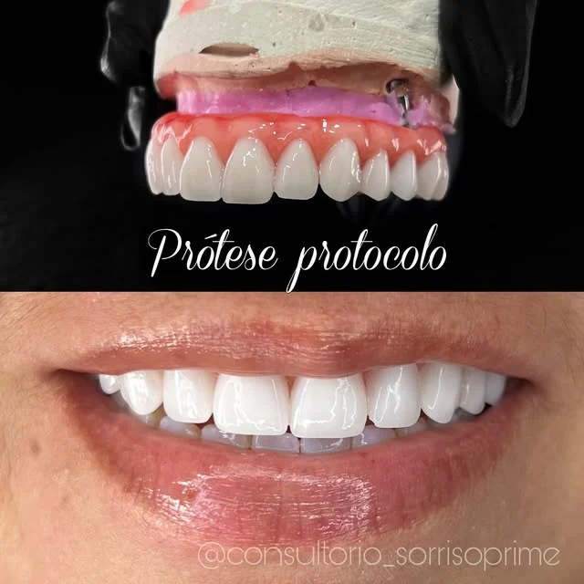 Prótese protocolo sobre implantes